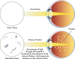 Causes of Eye Floaters. Why Do We See Floaters 