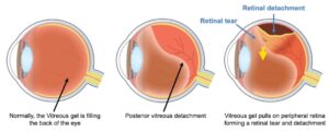 How Vitreous Detachment Can Lead to Retinal Detachment