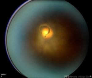 A Ring or Circle Shaped Floater from Posterior Vitreous Detachment At the Optic Disc
