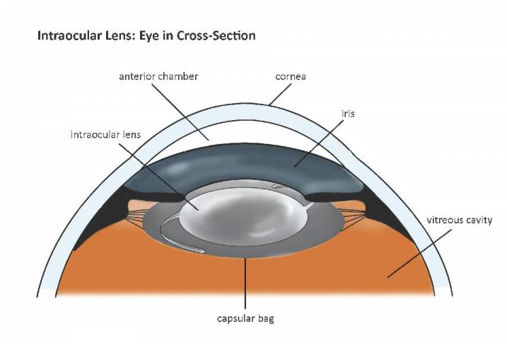 Intraocular Lens: Eye in Cross-Section 