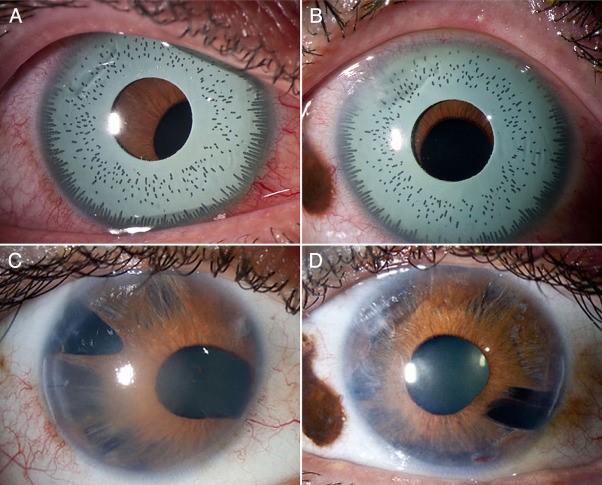 Permanent Eye Damage from Iris Implants