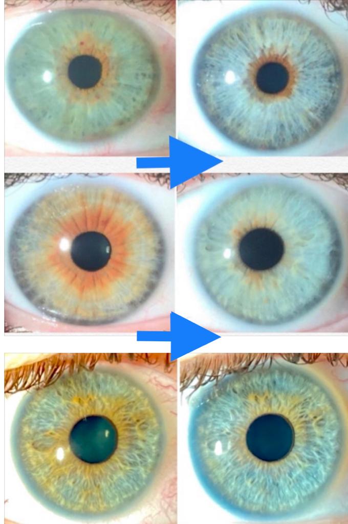 Laser Depigmentation of Iris 