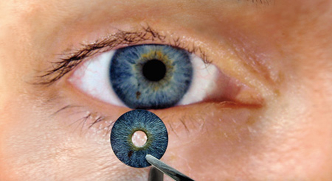 Artificial Iris Implants